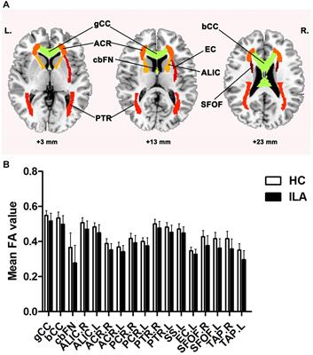 Disrupted Structural Brain Connectome Is Related to Cognitive Impairment in Patients With Ischemic Leukoaraiosis